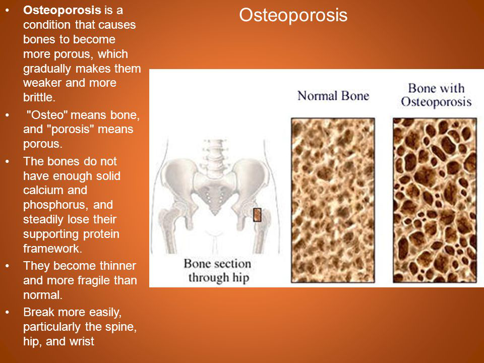 Osteoporosis Disease